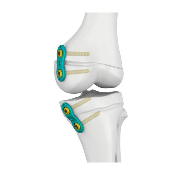 3.0/4.5mm Sehemu ya Epifise