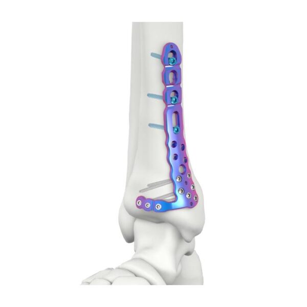 VAL Plaka ya Kufungua Tibial ya Medial ya Distal