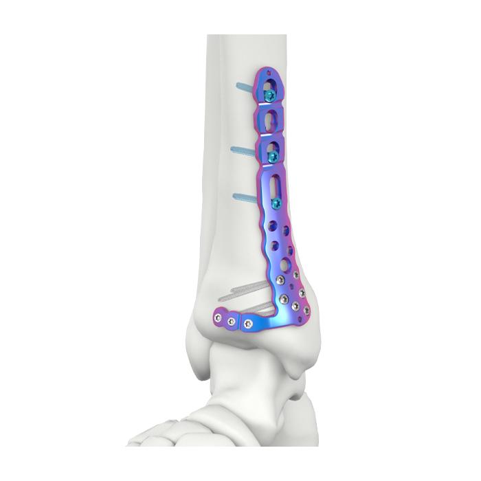 VAL Plaka ya Kufungua Tibial ya Medial ya Distal