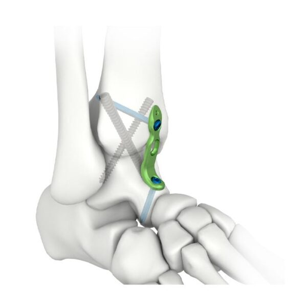 MIS Ankle Fusion Locking Plate
