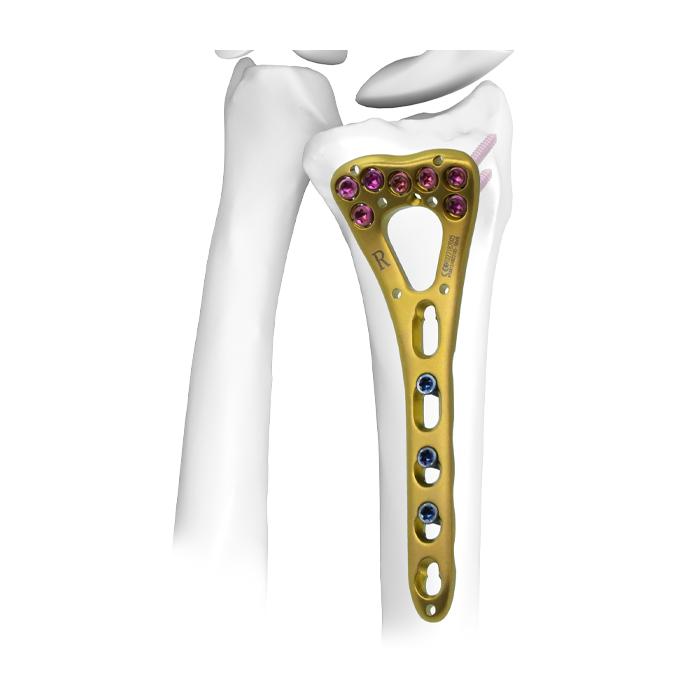 Plati ya Kufungwa kwa Radius ya Distal Ⅰ