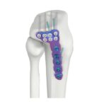 VAL Proksimali Lateral Tibial DR Kupiga Plati