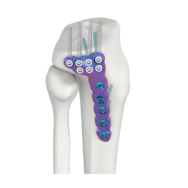 VAL Proksimali Lateral Tibial DR Kupiga Plati