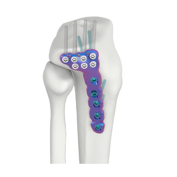 VAL Proksimali Lateral Tibial DR Kupiga Plati