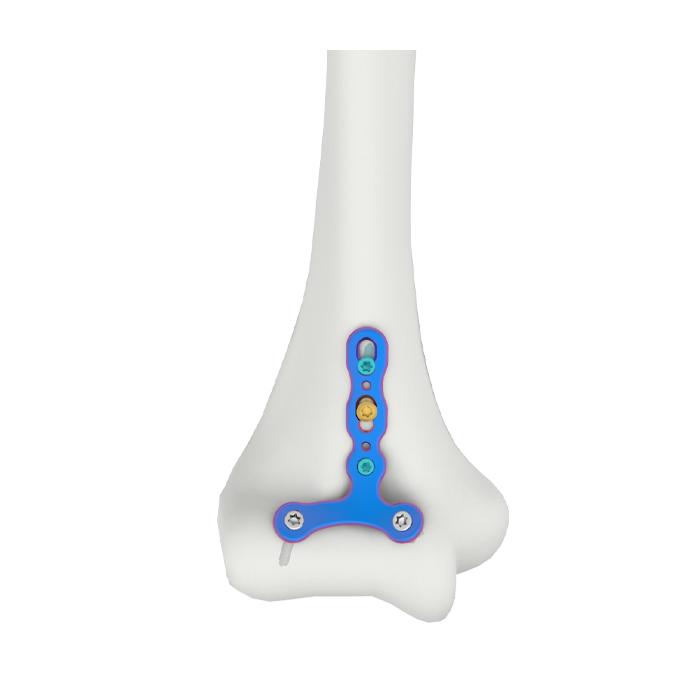 Val Humeral Capitellum Trochlea Locking Plate