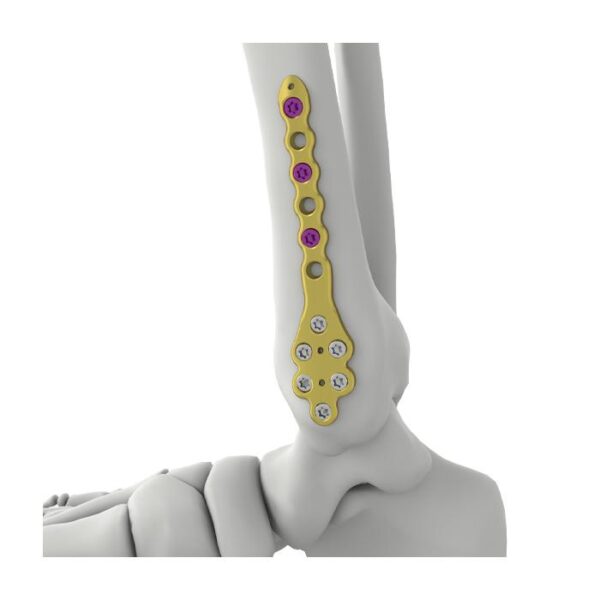 Itval Distal Medial Tibial Locking Plate